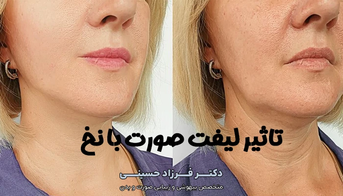 اثر لیفت صورت با نخ