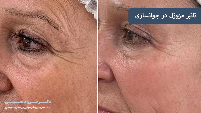 تاثیر مزوژل برای جوانسازی