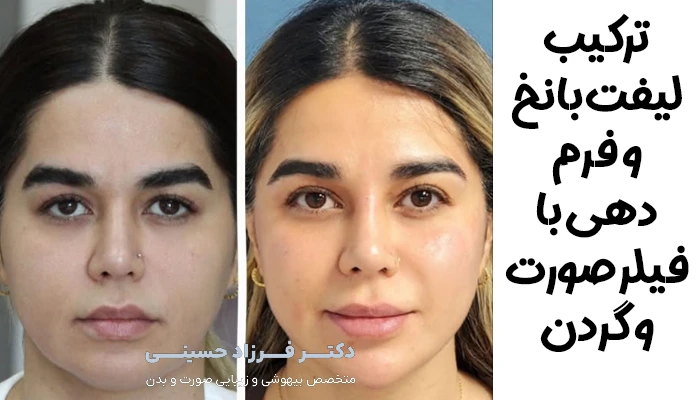ترکیب لیفت نخ با فیلر