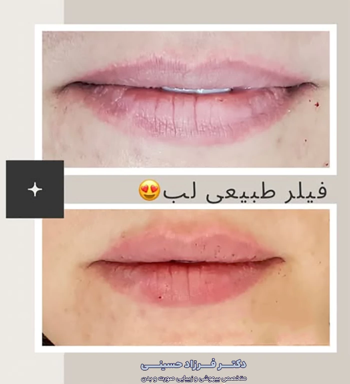 فیلر طبیعی لب