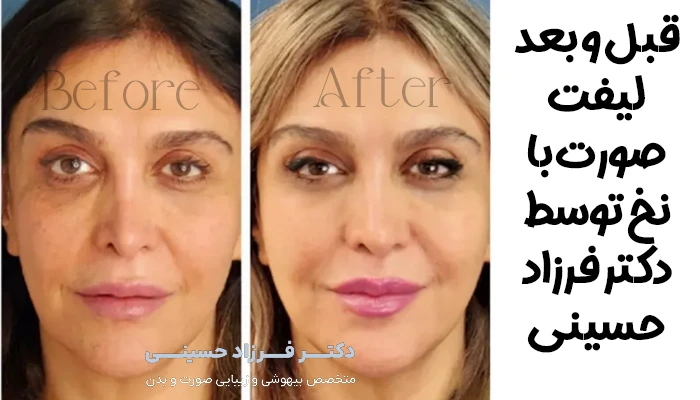 قبل و بعد لیفت صورت با نخ