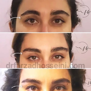 لیفت ابرو با نخ