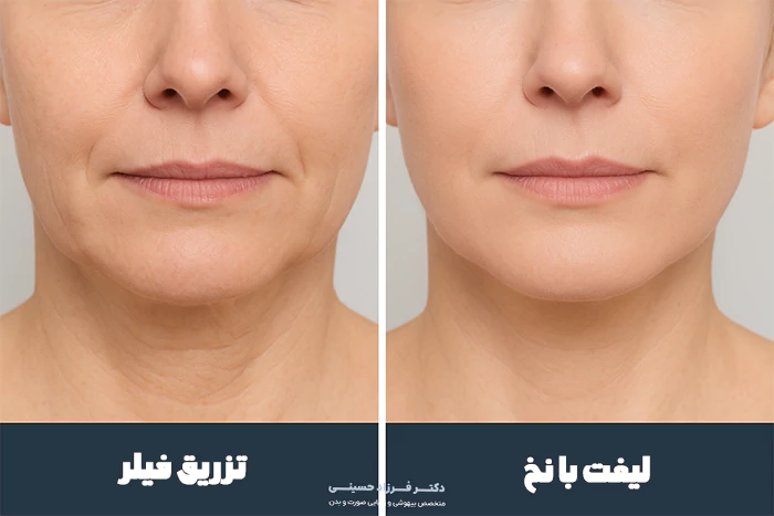 لیفت با نخ بهتره یا فیلر