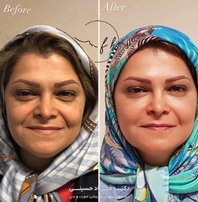 لیفت صورت با نخ