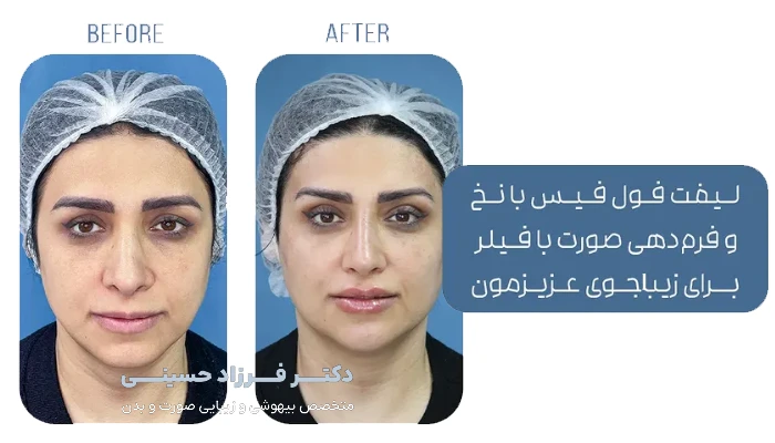 لیفت فول فیس با نخ