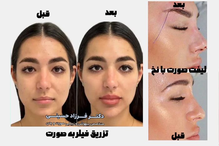 نتیجه تزریق فیلر و لیفت با نخ