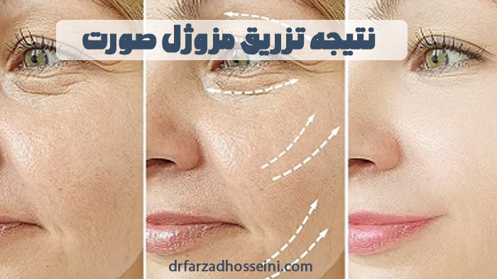نتیجه تزریق مزوژل