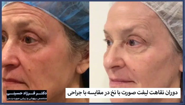 دوران نقاهت لیفت صورت با نخ در مقایسه با جراحی